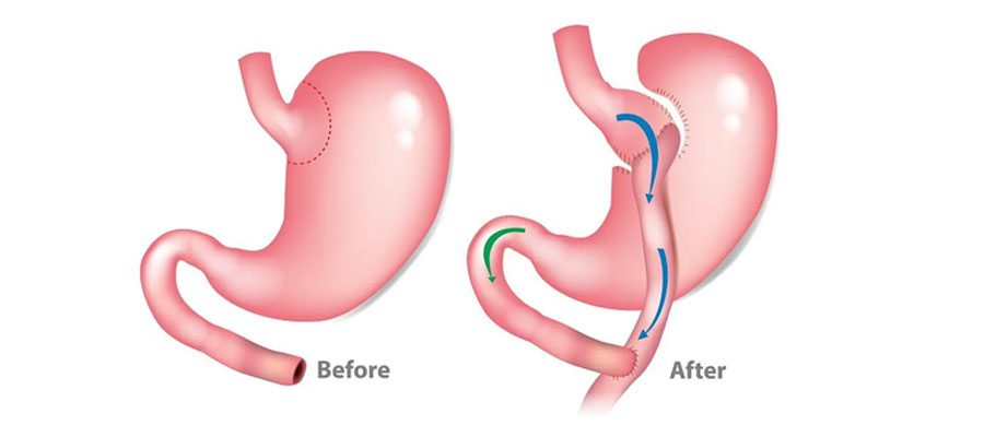 R&Y Gastric Bypass
